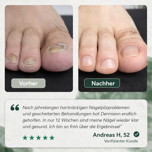 3× Nagelpilz Präzisionsstift